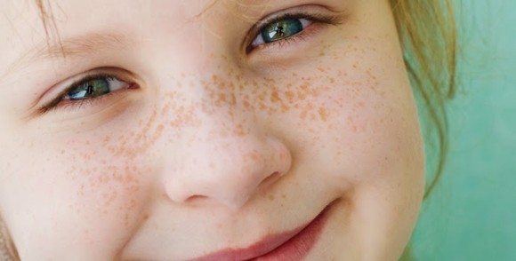 freckle-